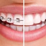 OrthoWax-Orthodontic-Wax-Mint-(CareDent),