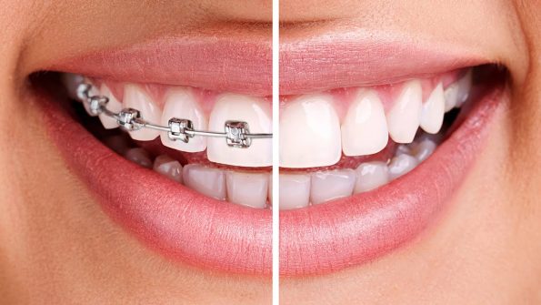 CareDent OrthoWax Orthodontic Wax Braces Mint Flavour Denta..