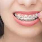 OrthoWax-Orthodontic-Wax-Mint-(CareDent),