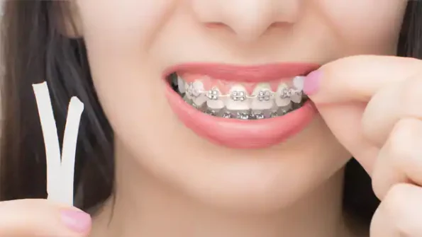 CareDent OrthoWax Orthodontic Wax Braces Mint Flavour Dental.